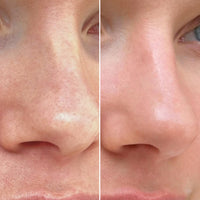 SALICYLIC ACID EXFOLIANT