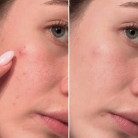 CLEARING SPOT PATCHES