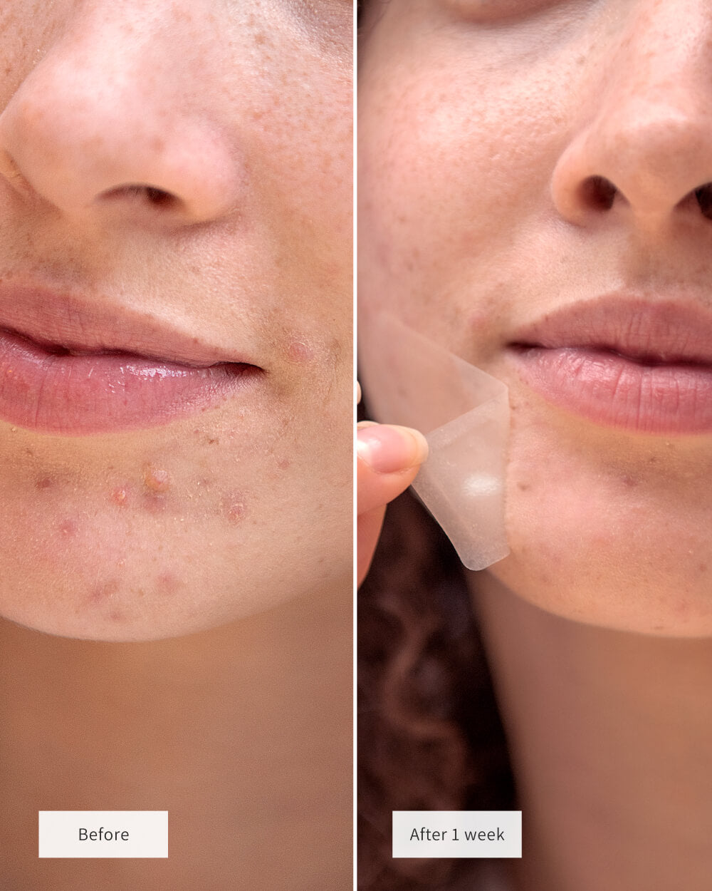 BANDAS DE SUPERFÍCIE PARA ACNE