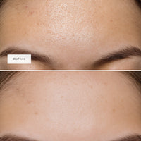 FOREHEAD PATCHES
