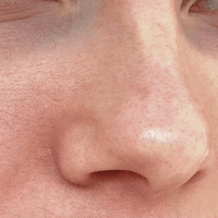 EXFOLIANT À L’ACIDE SALICYLIQUE