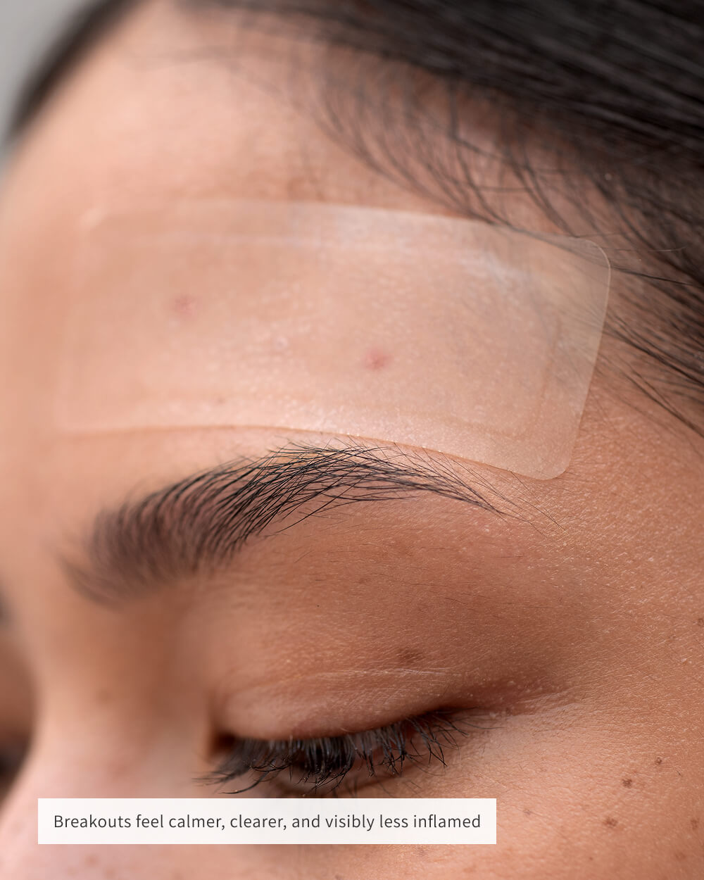 BANDAS DE SUPERFÍCIE PARA ACNE