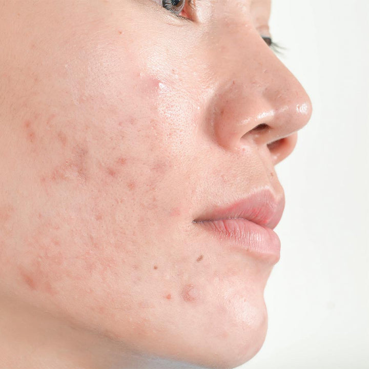 4 Types of Acne: Identifying and Treating Each One