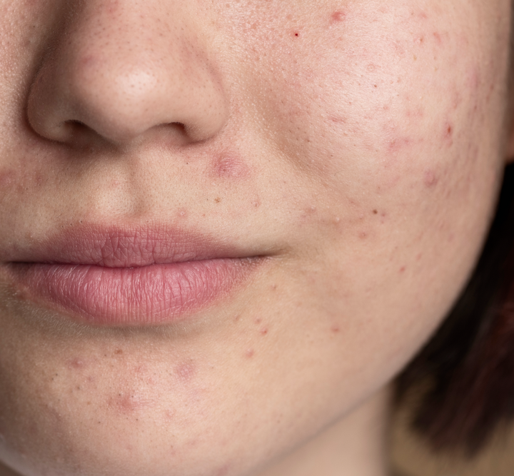 Acne Explained: What’s Happening Under Your Skin?