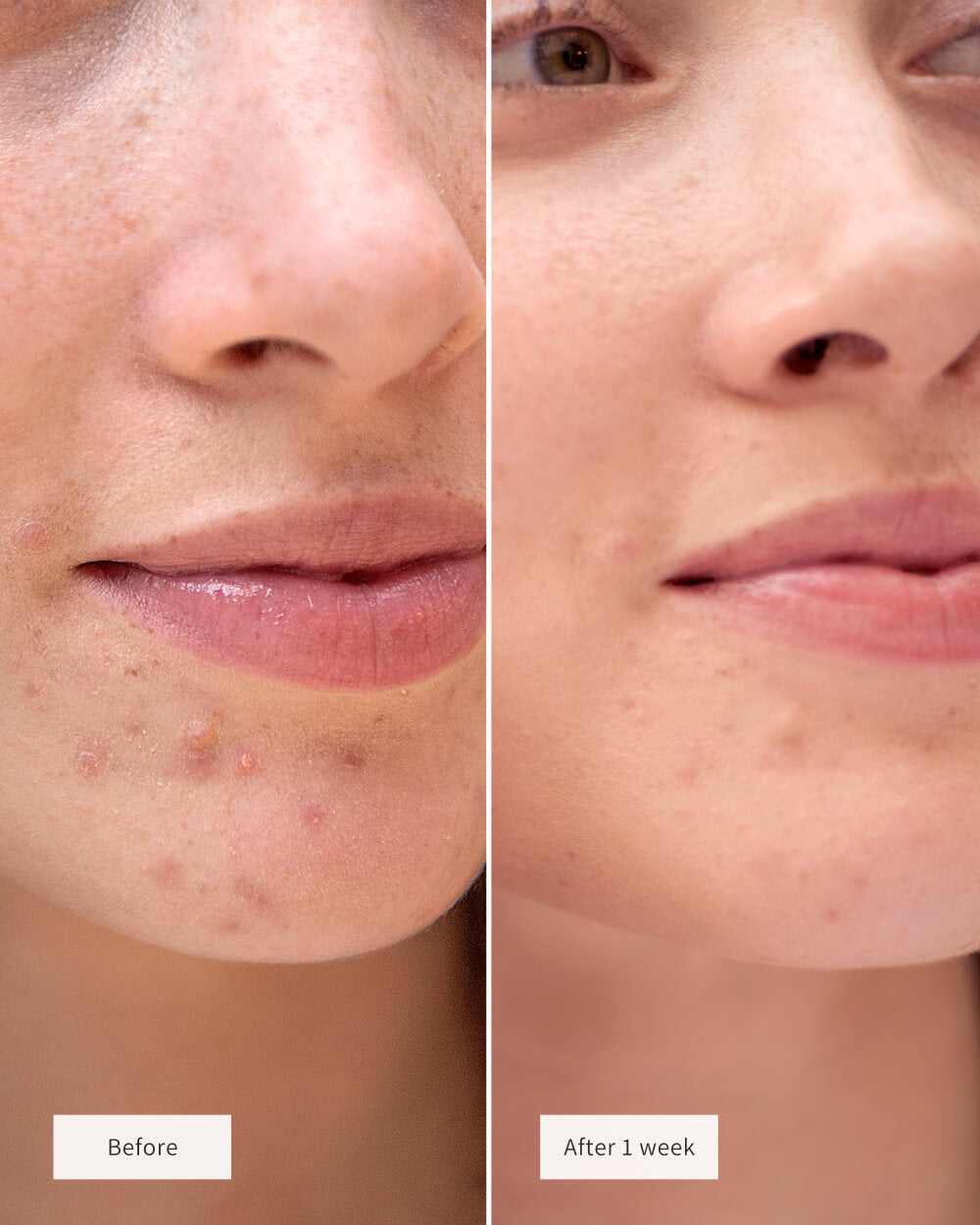 HEARTED SPOT PATCHES