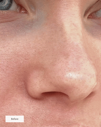 EXFOLIANT À L’ACIDE SALICYLIQUE